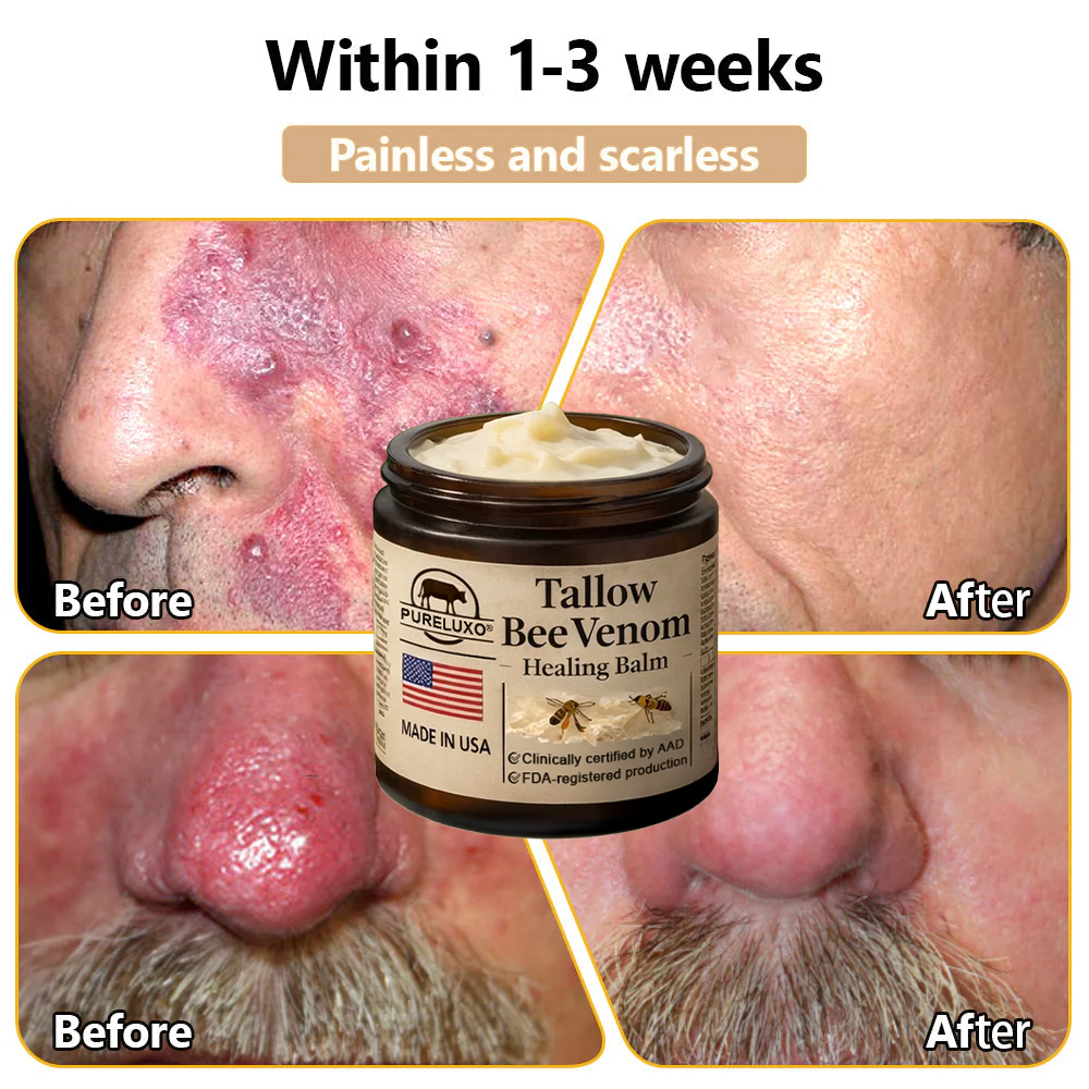 【70% OFF Ends Today】Pureluxo® 🐄Tallow Bee Venom Healing Balm（Targets Bumps, Wrinkles & Stressed Skin — Without Steroids）