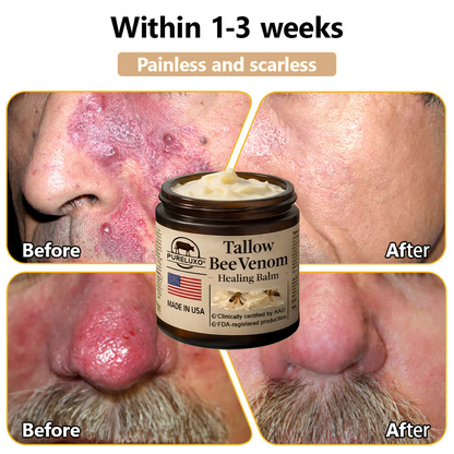 【70% OFF Ends Today】Pureluxo® 🐄Tallow Bee Venom Healing Balm（Targets Bumps, Wrinkles & Stressed Skin — Without Steroids）