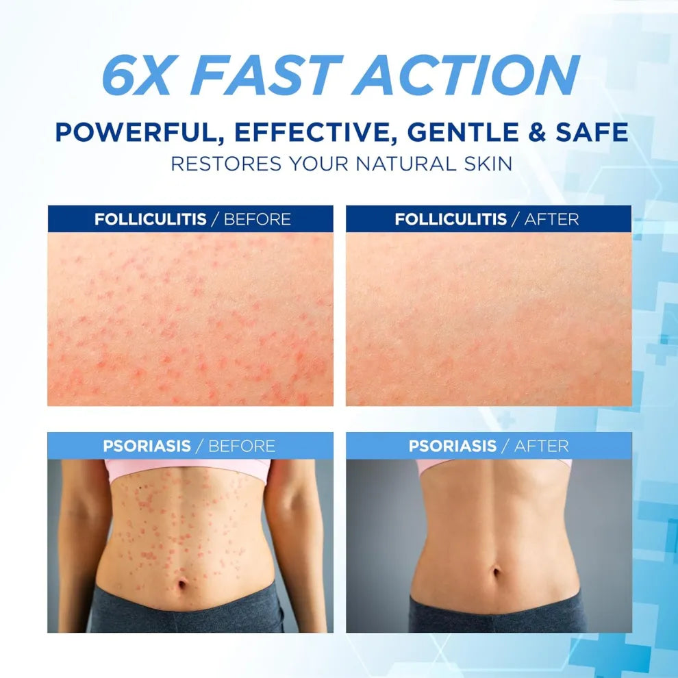 Folliculitis Treatment Cream: Effective Treatment for Folliculitis Scalp Face and Body 100g