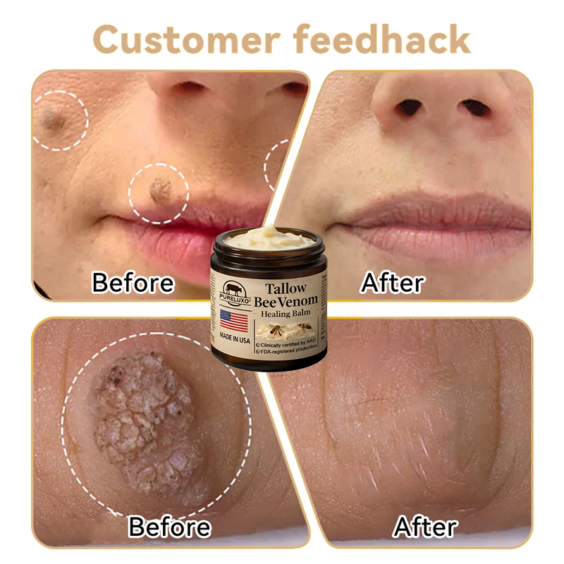 【70% OFF Ends Today】Pureluxo® 🐄Tallow Bee Venom Healing Balm（Targets Bumps, Wrinkles & Stressed Skin — Without Steroids）