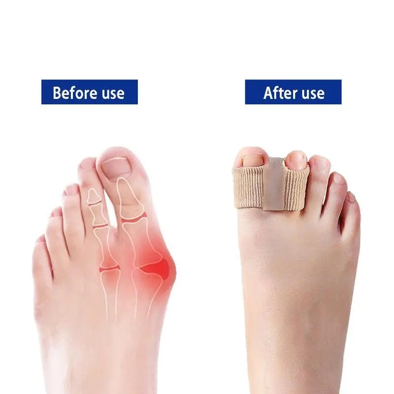 🛑 Tired of Bunion Pain? It's More Than Just a "Sore Toe". Discover the #1 Silicone Toe Separator for All-Day Relief!
